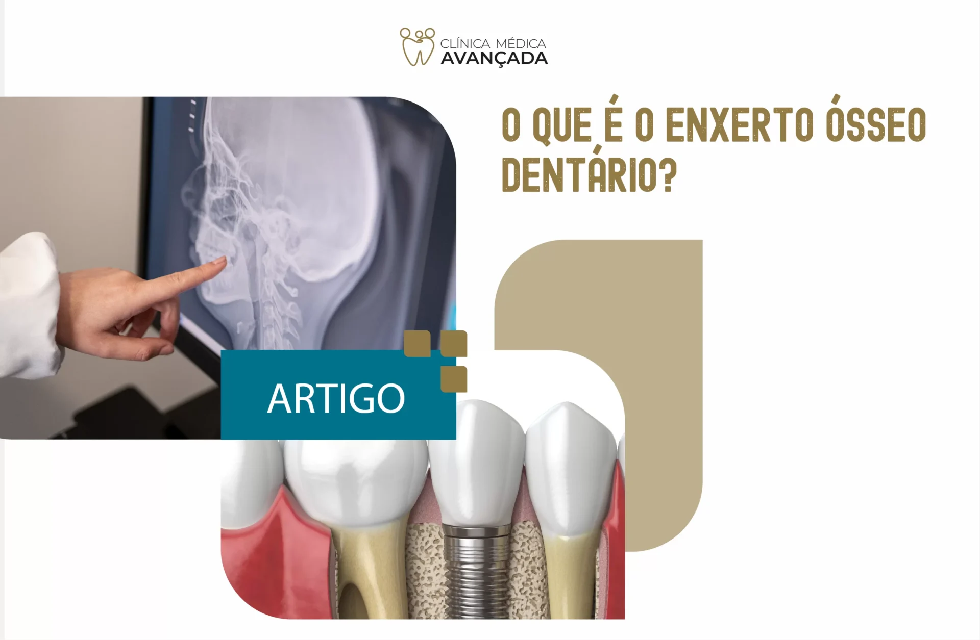 Enxerto ósseo dentário - Clinica Médica Avançada